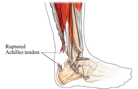 Achilles Tendon Rupture