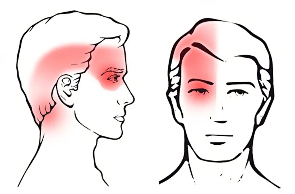 Cervicogenic Headaches and Migraines: How to Tell If It's Coming From Your Neck (and What Physio Can Do)
