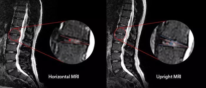MRI for Back Pain: When You Actually Need One (and When It Will Just Worry You)