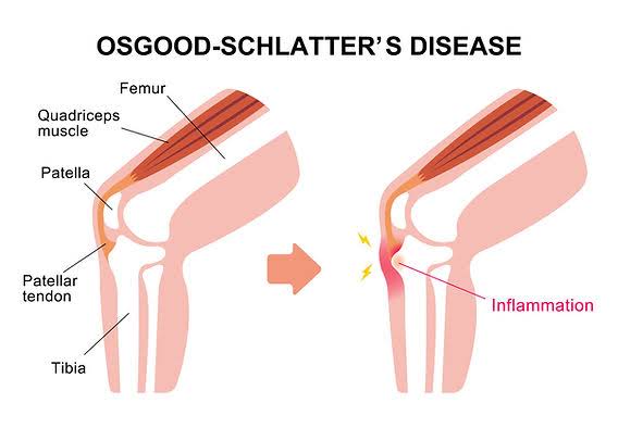 Sever's Disease and Osgood-Schlatter: A Parent's Guide to Heel and Knee Pain in Active Kids